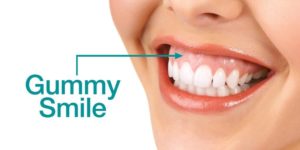 десневая улыбка gummy smile