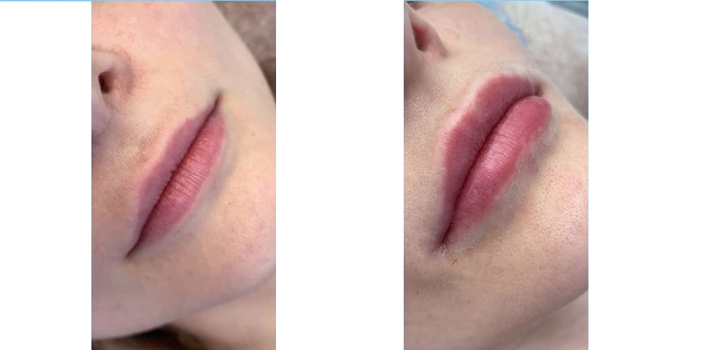 Face non surgery contour plastic (filler injection) Kyiv - Esteva