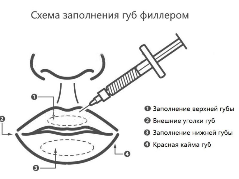 Техники увеличения губ филлерами схемы и названия