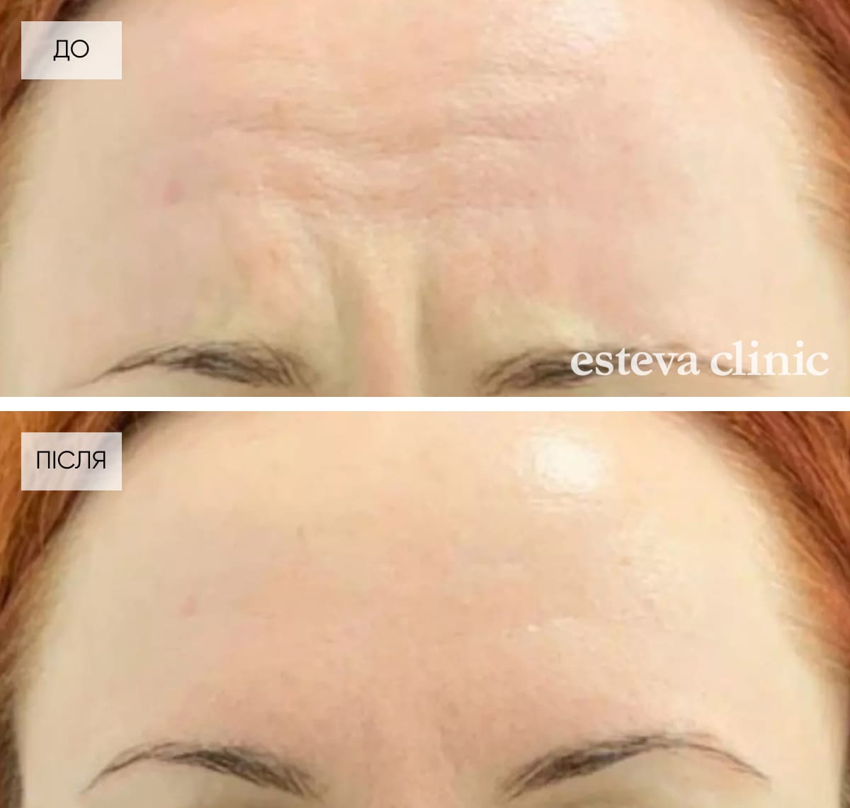 How to remove wrinkles effective methods of cosmetology